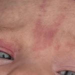 Angel Kiss Birthmark The Spiritual Meaning Behind