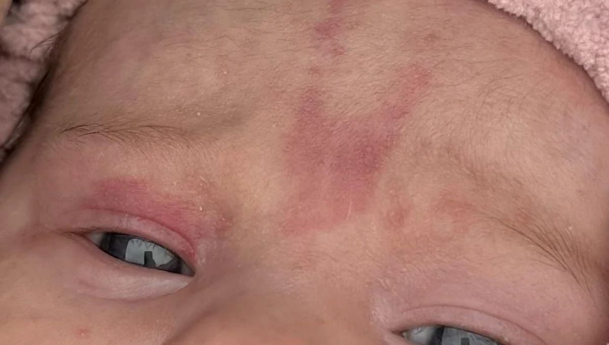 Angel Kiss Birthmark The Spiritual Meaning Behind