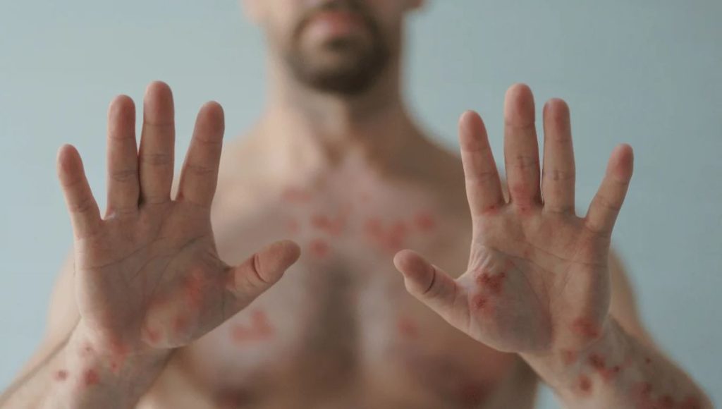 Medication Side Effects That Cause Itchy Hands